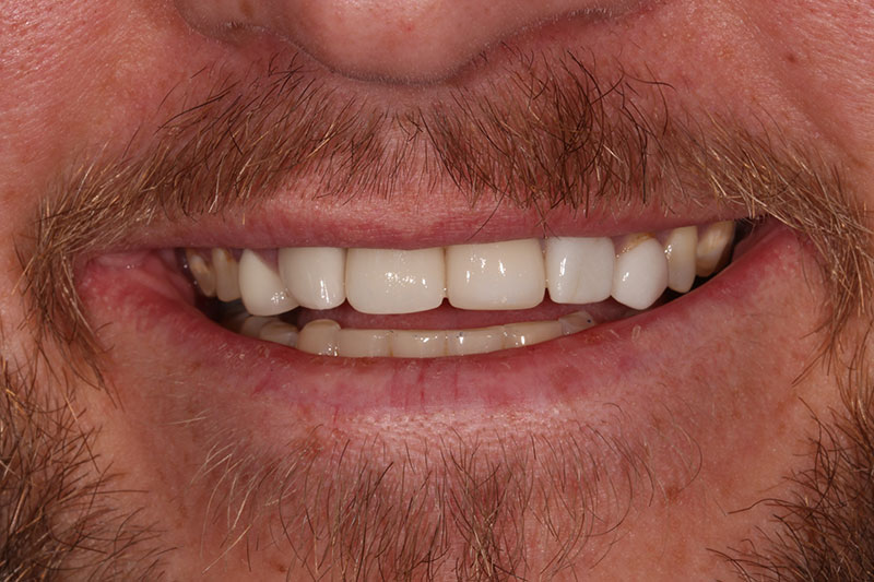 After image