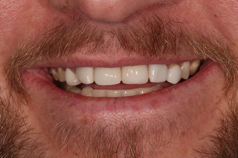 After image