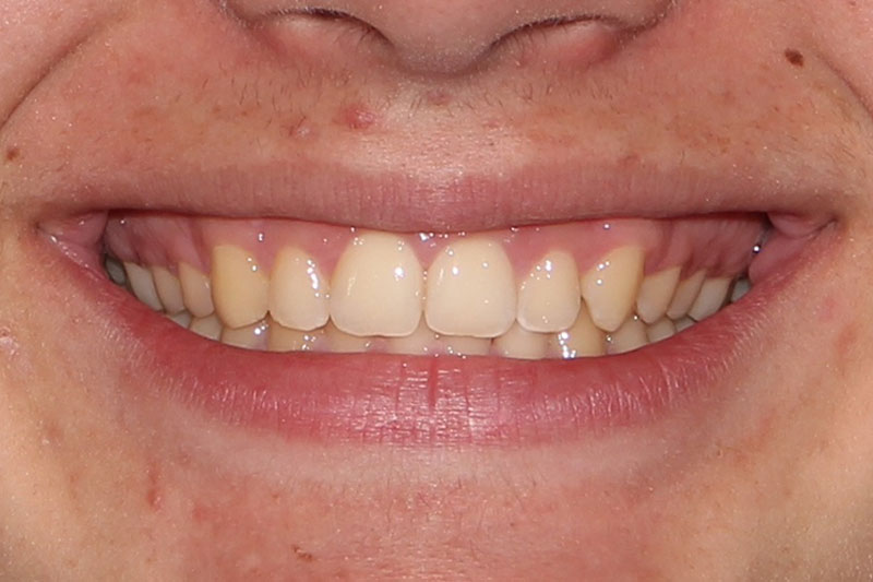 After image