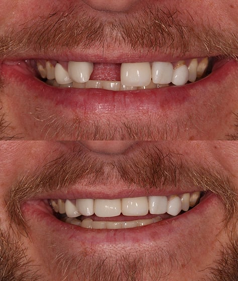 Dental implants before and after