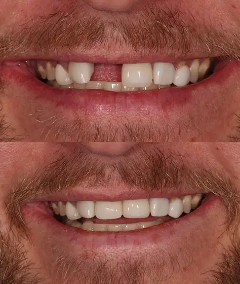 Dental implants before and after