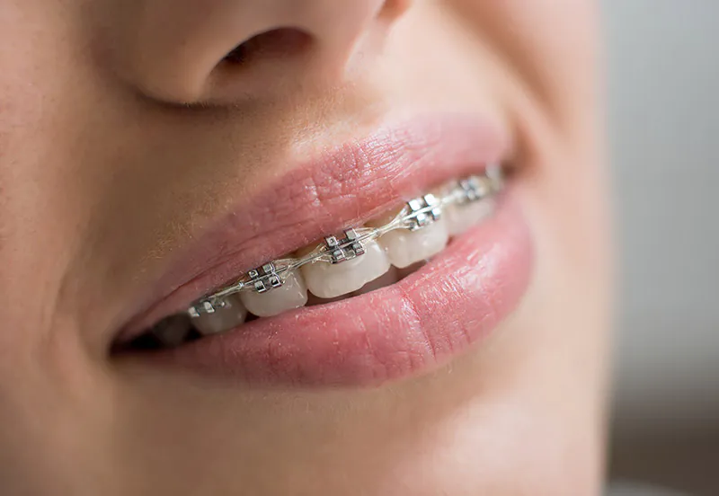 orthodontic options at Center for Dental Excellence