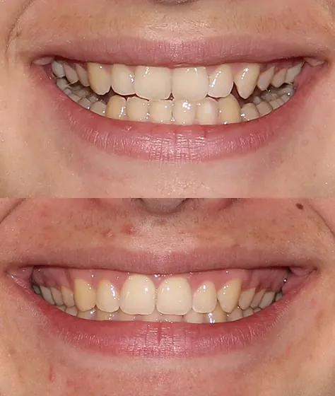 Orthodontics before and after