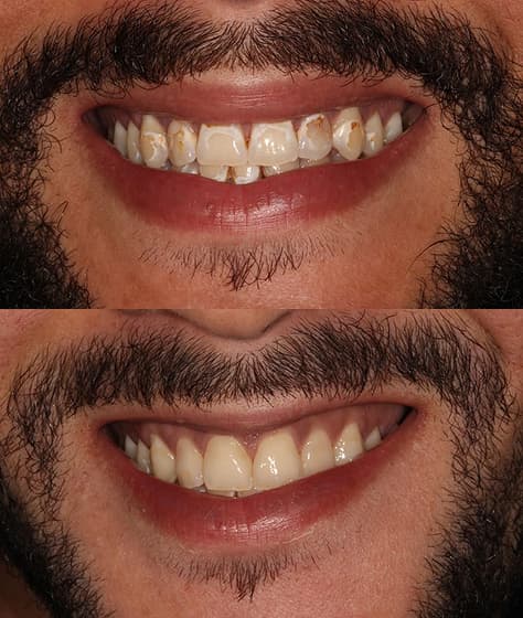 Smile makeover before and after