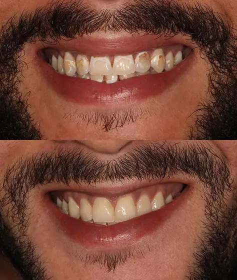 Smile makeover before and after